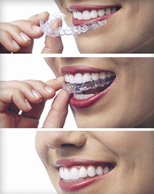 Invisalign Allen Park dental patient with new smile