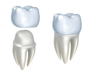 Dental crowns for dental emergencies in Allen Park