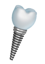 dental implants procedure in Allen Park