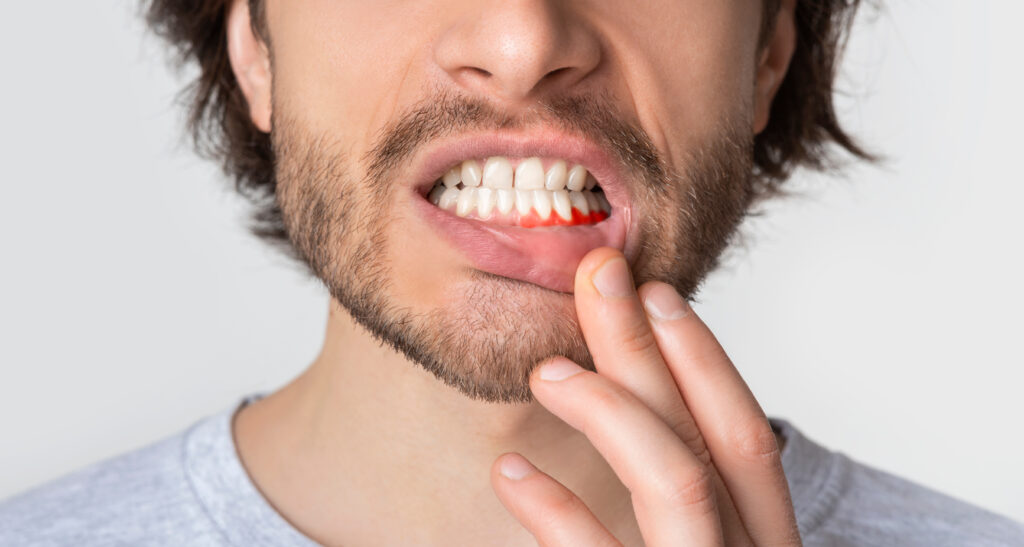 Man with red swollen gums an early sign of gum disease in Allen Park